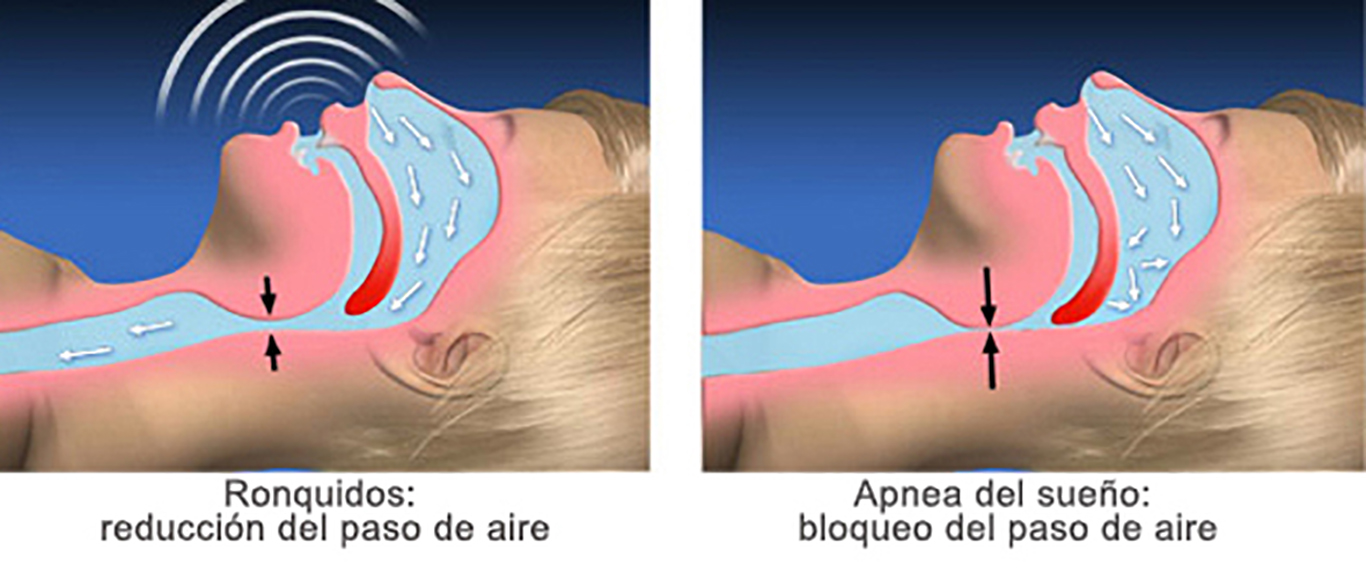 Diagnóstico de la apnea del sueño con ApneaLink - Garcelán Clinic