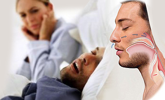 Tratamiento apnea ronquido monterrey